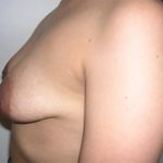 Breast Lift Before & After Patient #2288