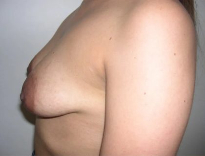 Breast Lift Before & After Patient #2288