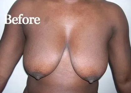 Mommy Makeover Before & After Patient #2949