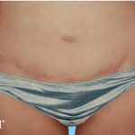 Mommy Makeover Before & After Patient #2939