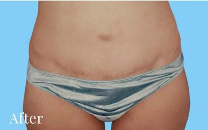 Mommy Makeover Before & After Patient #2939