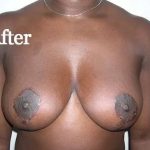 Mommy Makeover Before & After Patient #2949