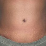 Mommy Makeover Before & After Patient #2929