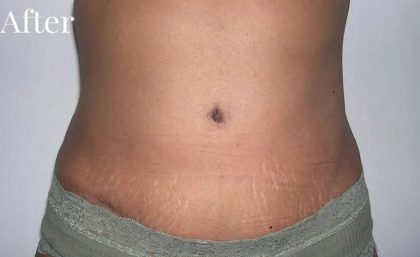 Mommy Makeover Before & After Patient #2929