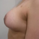 Breast Lift Before & After Patient #2288