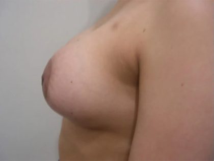 Breast Lift Before & After Patient #2288
