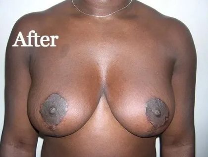 Mommy Makeover Before & After Patient #2949