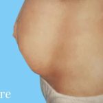 Mommy Makeover Before & After Patient #2939