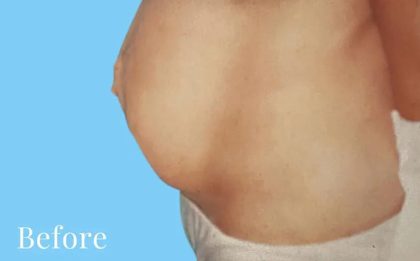 Mommy Makeover Before & After Patient #2939