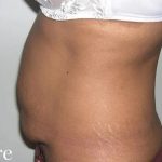 Mommy Makeover Before & After Patient #2929