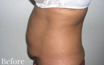 Mommy Makeover Before & After Patient #2929