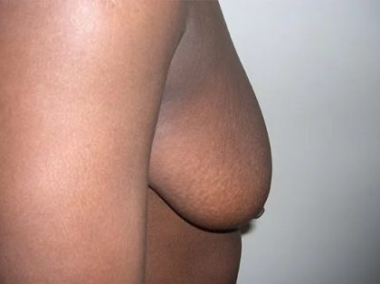 Breast Lift Before & After Patient #2283