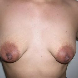 Breast Lift Before & After Patient #2288