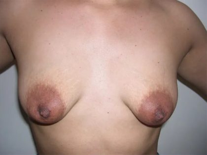 Breast Lift Before & After Patient #2288