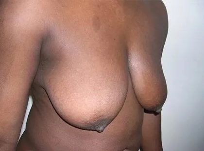 Mommy Makeover Before & After Patient #2949