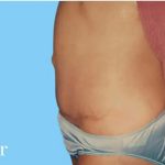 Mommy Makeover Before & After Patient #2939