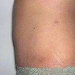 Mommy Makeover Before & After Patient #2929