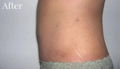 Mommy Makeover Before & After Patient #2929