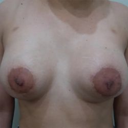 Breast Lift Before & After Patient #2288