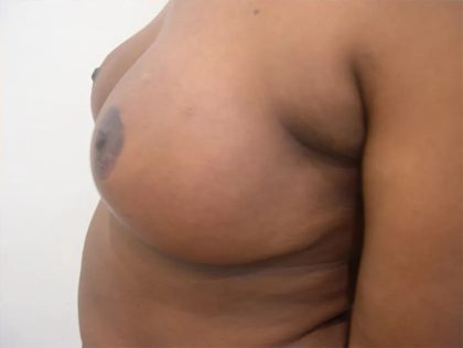Breast Reduction Before & After Patient #2317