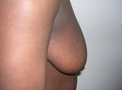 Mommy Makeover Before & After Patient #2949