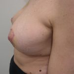 Breast Lift Before & After Patient #3742