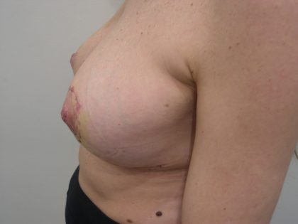 Breast Lift Before & After Patient #3742