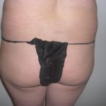 Buttock Augmentation Before & After Patient #4101
