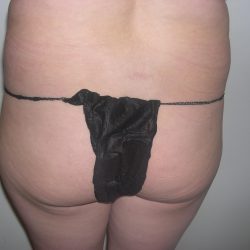 Buttock Augmentation Before & After Patient #4101