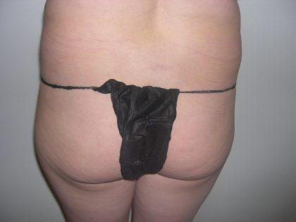 Buttock Augmentation Before & After Patient #4101