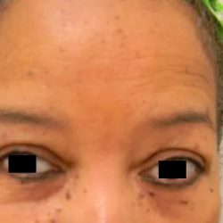 Eyelid Surgery Before & After Patient #3670