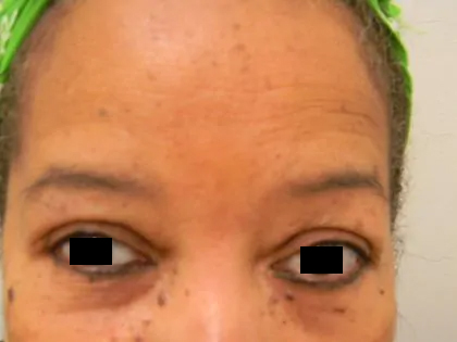 Eyelid Surgery Before & After Patient #3670