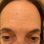 Botox Before & After Patient #4126