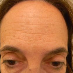Botox Before & After Patient #4126