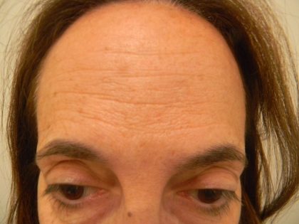 Botox Before & After Patient #4126