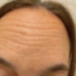 Botox Before & After Patient #4126