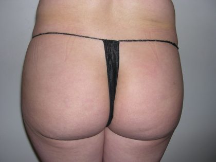 Buttock Augmentation Before & After Patient #4101