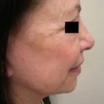 Facelift Before & After Patient #3785