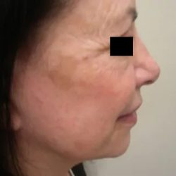 Facelift Before & After Patient #3785