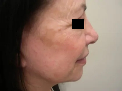 Facelift Before & After Patient #3785