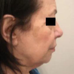 Facelift Before & After Patient #3785