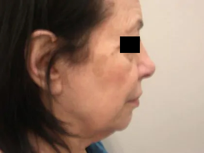 Facelift Before & After Patient #3785