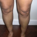 Fat Transfer to Calves Before & After Patient #3793