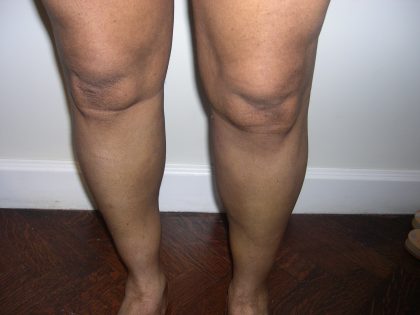 Fat Transfer to Calves Before & After Patient #3793