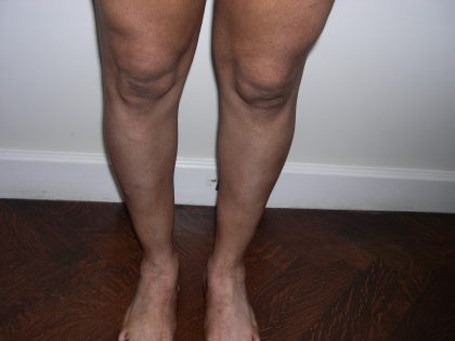 Fat Transfer to Calves Before & After Patient #3793