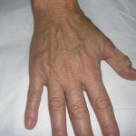 Fat Transfer to Hands Before & After Patient #3798