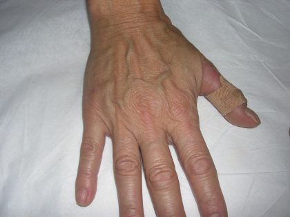 Fat Transfer to Hands Before & After Patient #3798