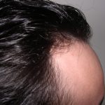 Hair Restoration Before & After Patient #3877