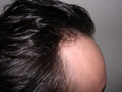 Hair Restoration Before & After Patient #3877