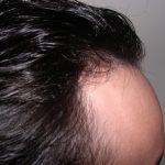 Hair Restoration Before & After Patient #2751